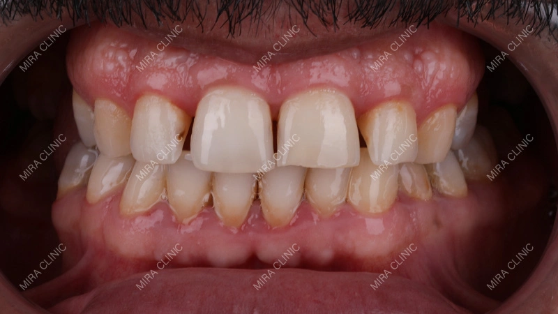 The gap is between existing teeth
